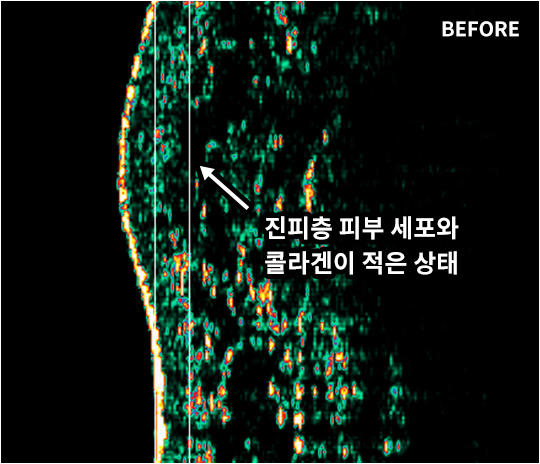 V&MJ Before 진피층 피부 세포와 콜라겐이 적은 상태