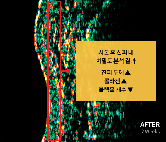 시술 후 진피 내 치밀도 분석 결과 진피 두께 상승, 콜라켄 상승, 블랙홀 개수 하락