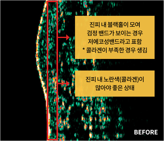 진피 내 블랙홀이 모여 검정 밴드가 보이는 경우 저에코성밴드라고 표함