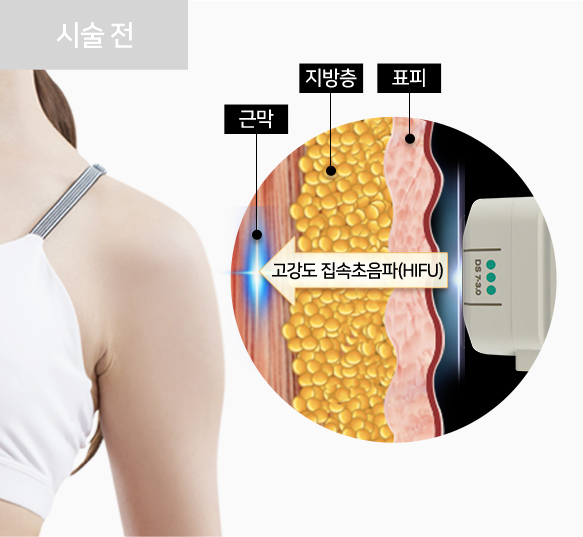 다이어트기계,테라노바기계,울쎄라리프팅,엉덩이리프팅,고주파관리,출산후뱃살,바디슈링크,다이어트기기,테라노바기기