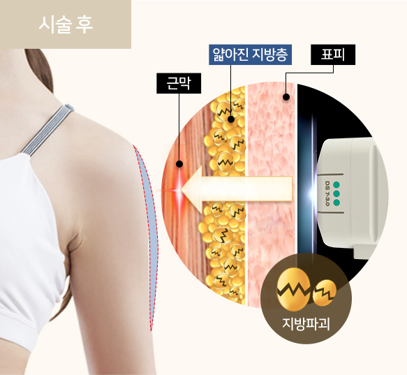 다이어트기계,테라노바기계,울쎄라리프팅,엉덩이리프팅,고주파관리,출산후뱃살,바디슈링크,다이어트기기,테라노바기기