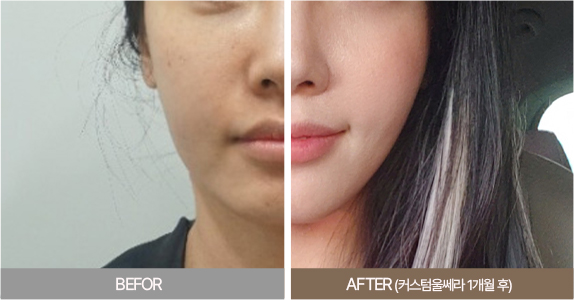 울쎄라전후,피부리프팅기기,얼굴리프팅,아이슈링크,슈링크리프팅,리프팅기구,홈케어슈링크,홈케어리프팅,인모드레이저,피부마사지기