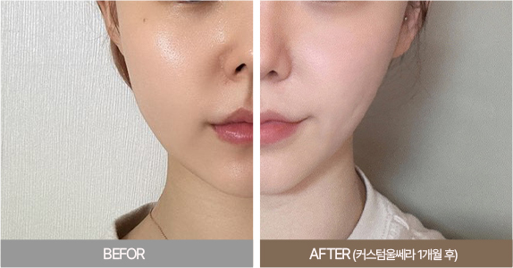 울쎄라전후,피부리프팅기기,얼굴리프팅,아이슈링크,슈링크리프팅,리프팅기구,홈케어슈링크,홈케어리프팅,인모드레이저,피부마사지기