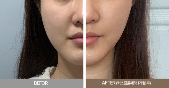 울쎄라전후,피부리프팅기기,얼굴리프팅,아이슈링크,슈링크리프팅,리프팅기구,홈케어슈링크,홈케어리프팅,인모드레이저,피부마사지기