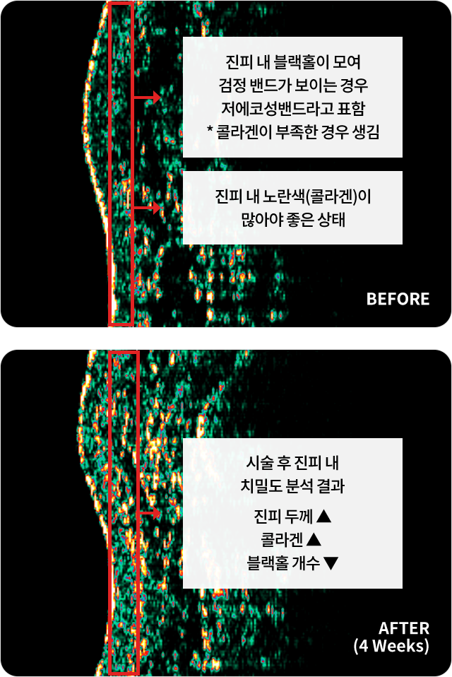 리쥬란힐러효과,스킨보톡스,리쥬메이트,리쥬란HB,쥬베룩,리쥬란HB플러스,리쥬란아이,리주란,리쥬란피부과