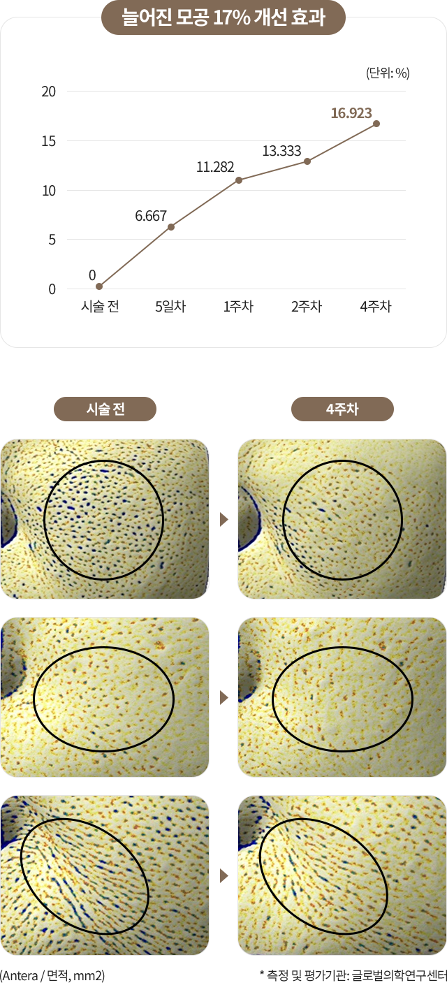 리쥬란힐러효과,스킨보톡스,리쥬메이트,리쥬란HB,쥬베룩,리쥬란HB플러스,리쥬란아이,리주란,리쥬란피부과
