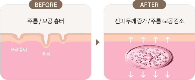 리쥬란힐러효과,스킨보톡스,리쥬메이트,리쥬란HB,쥬베룩,리쥬란HB플러스,리쥬란아이,리주란,리쥬란피부과
