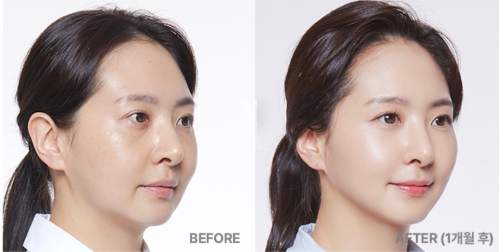 리쥬란힐러효과,스킨보톡스,리쥬메이트,리쥬란HB,쥬베룩,리쥬란HB플러스,리쥬란아이,리주란,리쥬란피부과