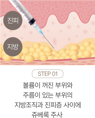 다리튼살,튼살관리,임신튼살,튼살제거비용,미라젯튼살,세진피부과튼살,흰색튼살레이저,튼살케어,임산부튼살치료,여드름파인흉터,등드름흉터제거,피부과흉터치료,패인흉터치료,코흉터