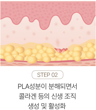다리튼살,튼살관리,임신튼살,튼살제거비용,미라젯튼살,세진피부과튼살,흰색튼살레이저,튼살케어,임산부튼살치료,여드름파인흉터,등드름흉터제거,피부과흉터치료,패인흉터치료,코흉터