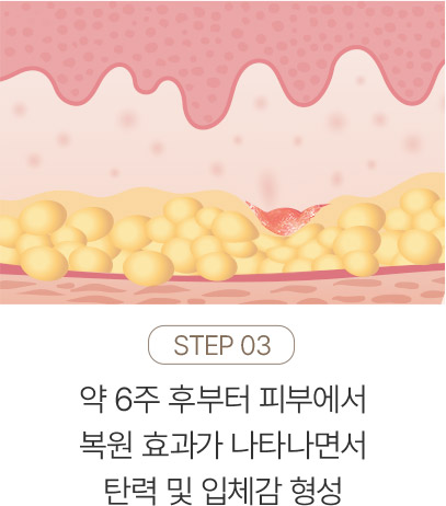 다리튼살,튼살관리,임신튼살,튼살제거비용,미라젯튼살,세진피부과튼살,흰색튼살레이저,튼살케어,임산부튼살치료,여드름파인흉터,등드름흉터제거,피부과흉터치료,패인흉터치료,코흉터