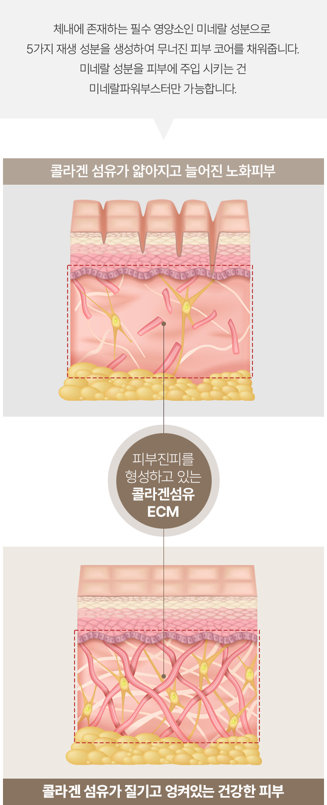 필러녹이기,필러,눈밑필러