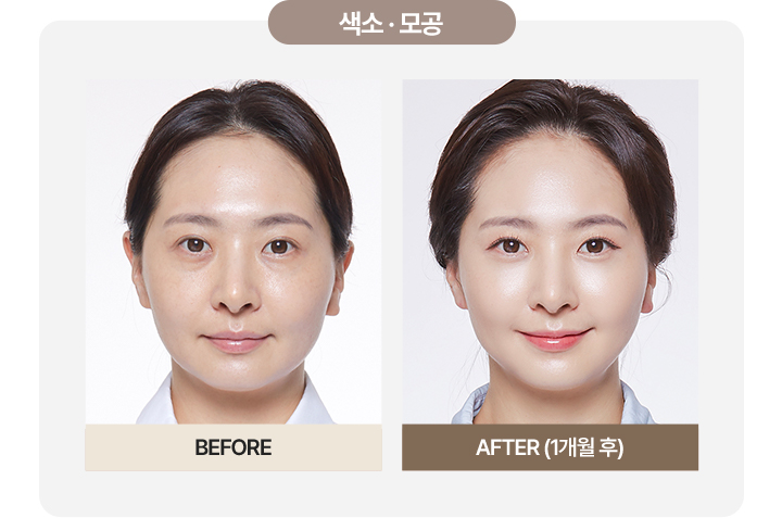 울쎄라전후,피부리프팅기기,얼굴리프팅,아이슈링크,슈링크리프팅,리프팅기구,홈케어슈링크,홈케어리프팅,인모드레이저,피부마사지기