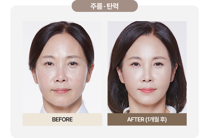 울쎄라전후,피부리프팅기기,얼굴리프팅,아이슈링크,슈링크리프팅,리프팅기구,홈케어슈링크,홈케어리프팅,인모드레이저,피부마사지기