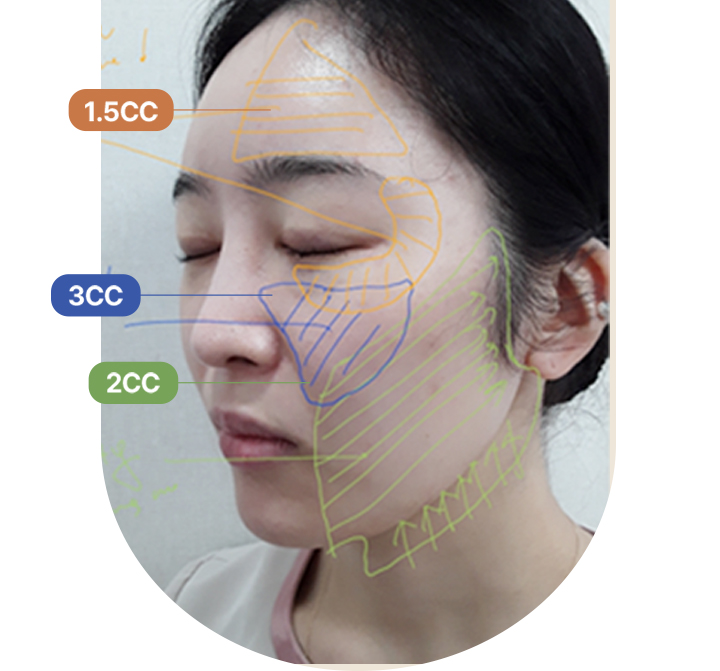리쥬란힐러효과,스킨보톡스,리쥬메이트,리쥬란HB,쥬베룩,리쥬란HB플러스,리쥬란아이,리주란,리쥬란피부과