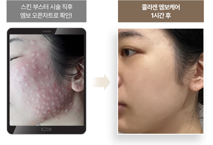 리쥬란힐러효과,스킨보톡스,리쥬메이트,리쥬란HB,쥬베룩,리쥬란HB플러스,리쥬란아이,리주란,리쥬란피부과