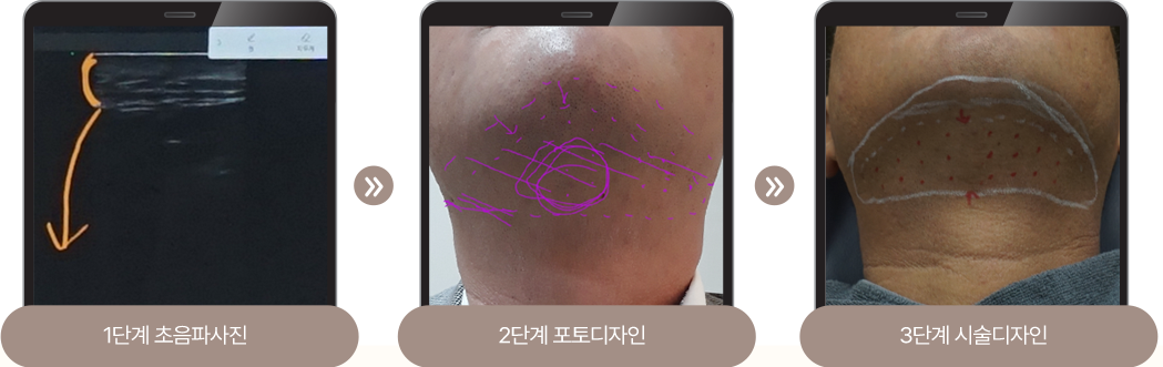 윤곽보톡스,사각턱주사,동안침,윤곽약침,매선,정안침,매선침,비만주사,이중턱살제거,불독살,팔자주름,얼굴리프팅,팔자주름없애기,윤곽주사전후,얼굴살빼는법,매선치료,실리프팅,지방이식,리프팅,팔자주름시술,심부볼제거,심부볼지방제거,얼굴실리프팅,한방코성형,턱살보톡스,얼굴살주사,볼살제거,볼살시술