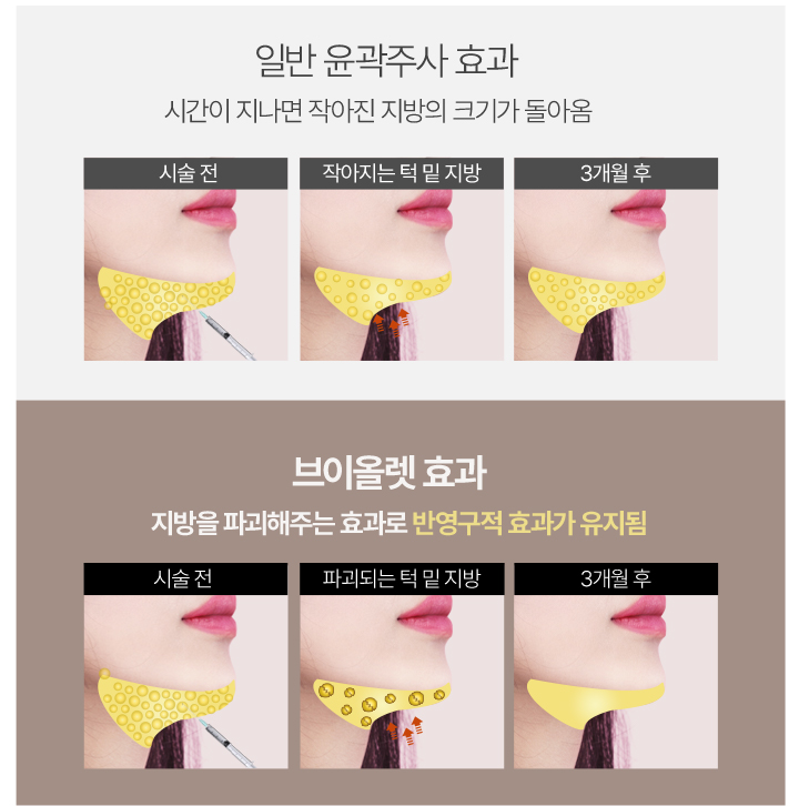브이컷주사,강남역윤곽주사,남자얼굴살,얼굴살시술,얼굴지흡,이중턱지방흡입,얼굴형시술,아큐스컬프,브이라인시술,쁘띠성형,피코프락셀,리니어펌,이중턱근육묶기,올리지오남역윤곽주사,남자얼굴살,얼굴살시술,얼굴지흡,이중턱지방흡입,얼굴형시술