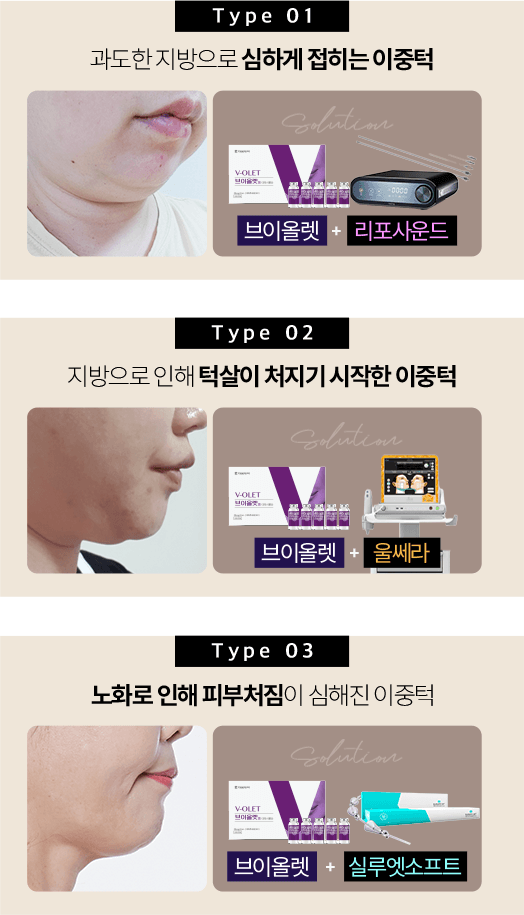 브이컷주사,강남역윤곽주사,남자얼굴살,얼굴살시술,얼굴지흡,이중턱지방흡입,얼굴형시술,피코토닝,리포사운드,파워윤곽주사,남자얼굴지방흡입,V라인시술,턱윤곽주사,심술보제거,남자턱살,윤곽시술,울쎄라,턱살제거,볼살빼는법,심부볼,광대지방흡입,얼굴살빼기,턱살지방흡입,이중턱지흡,이중턱살,이중턱지방흡입비용,턱지방흡입,이중턱지방흡입후기,볼살지방흡입,얼굴지방분해